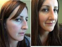Rhinoplasty after radiesse before and after
