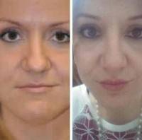 Rhinoplasty and chin implant how much cost
