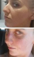 Rhinoplasty before after Baltimore top best plastic surgeons