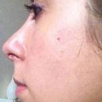 Rhinoplasty before after Boston top best plastic surgeons images