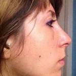 Rhinoplasty before after Florida top best plastic surgeons pics