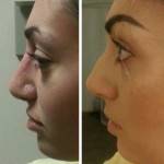 Rhinoplasty before after Jacksonville top best cosmetic surgeons photos