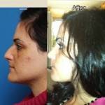 Rhinoplasty before after Las Vegas top best cosmetic surgeons pictures