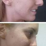 Rhinoplasty before after New orleans top best plastic surgeons shapshots