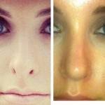 Rhinoplasty before after New orleans top best surgeons photos