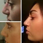 Rhinoplasty before after Sacramento cosmetic surgeons pictures