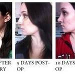 Rhinoplasty before after of post op pictures