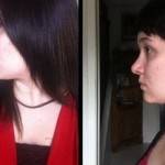 Rhinoplasty before after recovery timeline shapshot