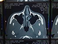 Rhinoplasty computer simulation image