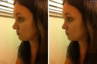 Rhinoplasty in India before and after photos patients