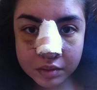 Rhinoplasty in Mexico pictures