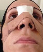 Rhinoplasty in Mexico recovery after