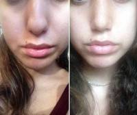 Rhinoplasty nostrils asymmetry before and after