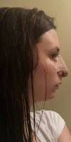 Rhinoplasty osteotomies surgery pictures