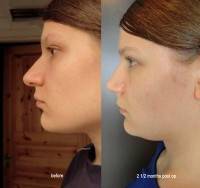 Rhinoplasty unhappy with results before and after