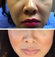 Rhinoplasty vs fillers before and after
