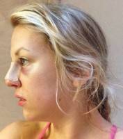 Thin skin rhinoplasty reovery after