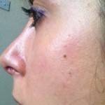 Tip rhinoplasty pictures Calgary top best cosmetic surgeons pictures