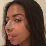 Tip rhinoplasty pictures New York best cosmetic surgeons photos