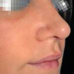 Tip rhinoplasty pictures Thailand best cosmetic surgeons shapshots