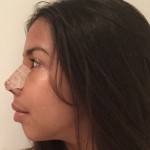 Tip rhinoplasty pictures UK top best surgeons images