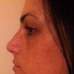 Tip rhinoplasty pictures of revision photo