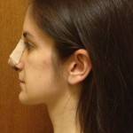 Tip rhinoplasty pictures swelling pic