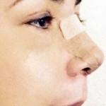 Uneven swelling after rhinoplasty operation