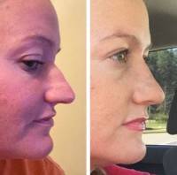 What to expect from rhinoplasty omages