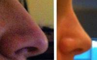 What to expect from rhinoplasty surgery photos