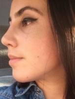 Young rhinoplasty at 17 years old