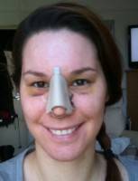 nasal tip refinement swelling