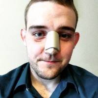 nose cast after rhinoplasty surgery