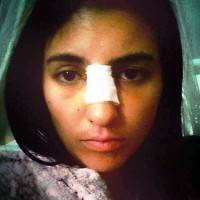 removal of cast after rhinoplasty operation