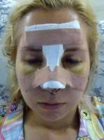 rhinoplasty for Button nose