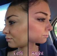 Closed Nose Surgery Rhinoplasty In Sydney, Cumberland Affords The Best Access And Results