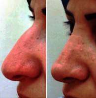 Plastic Surgery Nose In Australia Is Performed Under A General Anaesthetic And Takes Around Two Hours