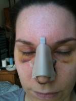 The Perfect Nose For A Woman In Sydney, AU With Help Of Rhinoplasty