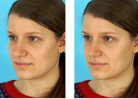 Ann Arbor Perfect Nose Size With Dr. Vasileff