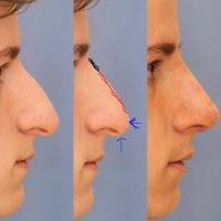 Ashok Govila, FRCS Dubai Male Surgery Of The Nose Before And After