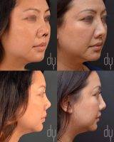 Asian Rhinoplasty In Phillipines Before And After