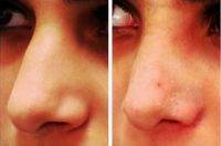 Beautiful Rhinoplasty In Texas Before And After