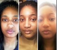 Before And After Chicago, IL Nose Job By Dr. Toriumi