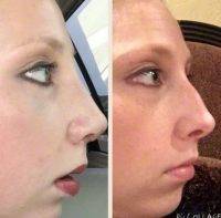 Before And After Cosmetic Surgery Of Nose In Beverly Hills Dorsal Hump Removal