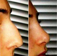 Before And After Grand Rapids MI Surgical Rhinoplasty