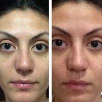 Before And After Miami Nose Reshaping Surgery
