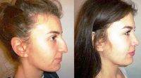 Before And After Nose Reshaping At La Jolla Cosmetic Surgery Centre, San Diego