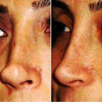 Before And After Nose Surgery In Orange County
