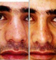 Before And After Operation On Nose In England For Man