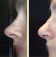 Before And After Plastic Nose Surgery In New Haven Connecticut